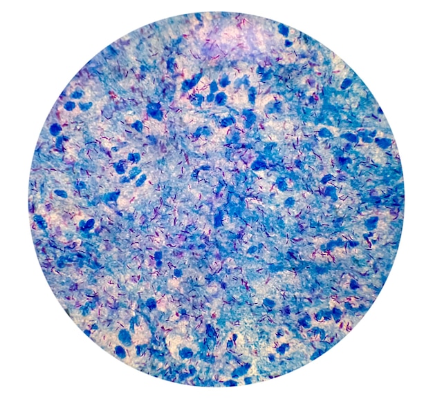 AFB stainig. Microbacterium Tuberculosis Bacteria (MTB). Sputum or phlegm smear. MTB (TB) diagnosis.