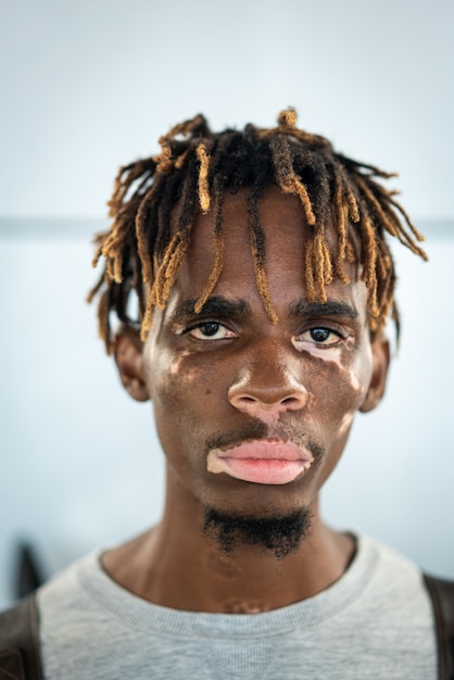 African american black young man with vitiligo skin