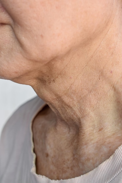 Aging skin folds or skin creases or wrinkles at neck