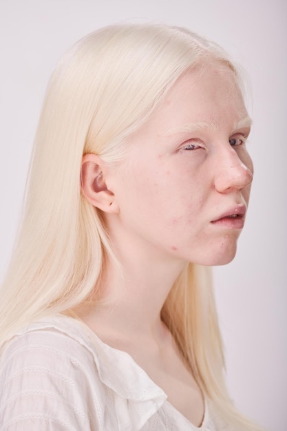 Albino woman with unusual appearance