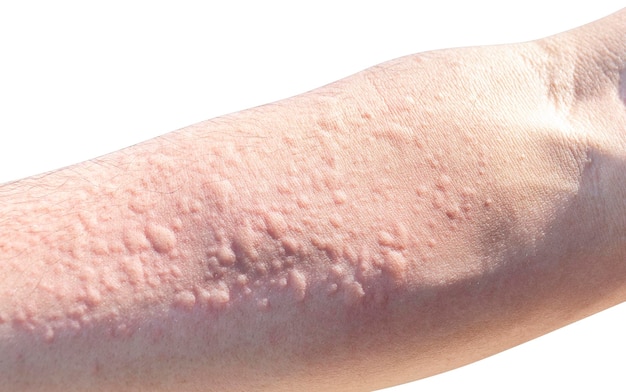 Photo allergic reaction to dust on arm isolated on white background with clipping path