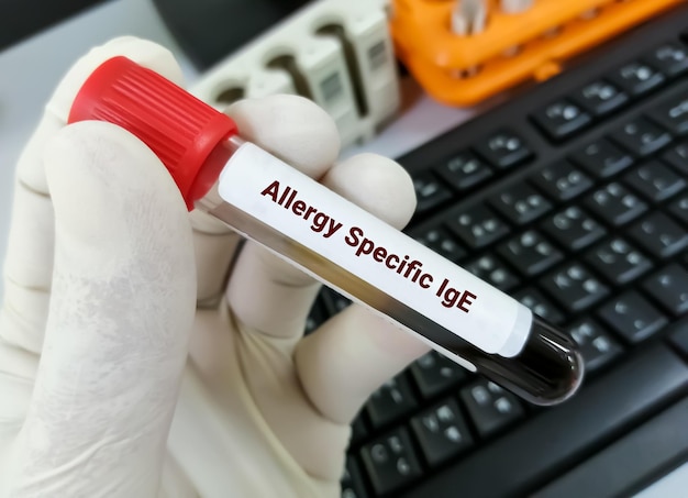 Photo allergy specific ige test or allergy testing for detect allergen substance cause allergic reaction