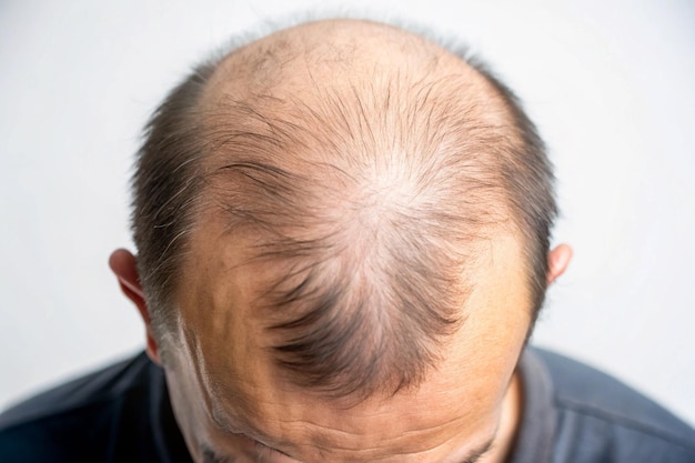 alopecia