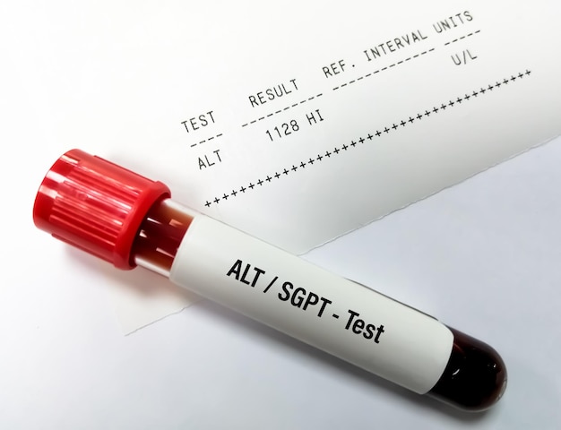 ALT test for Liver function test with abnormal patient report