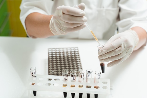 Analysis of blood plasma closeup Laboratory assistant hold test tube with blood from vein in his hands and looks at it Blood test in the laboratory