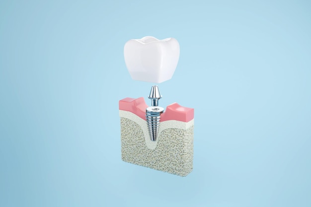 Anatomy Teeth dental implant with gum on blue background