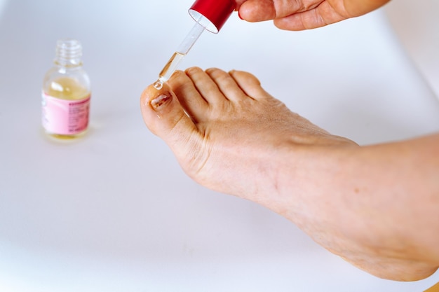 Applying oil with pipette to damaged toe nail