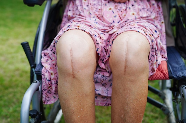 Asian elderly woman patient with scar knee replacement surgery in hospital