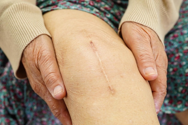 Asian elderly woman patient with scar knee replacement surgery in hospital