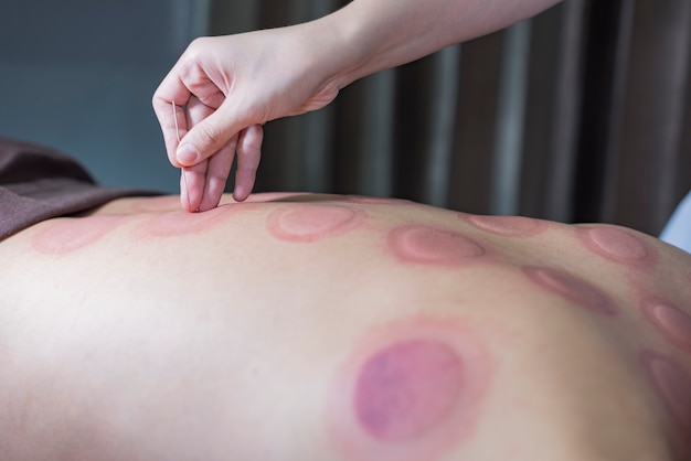 Asian man undergoing acupuncture treatment at the health spa massage after cupping treatme