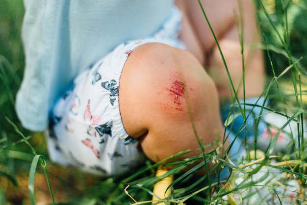 Baby knee with bloody scratch. Summer day on the grass. Toddler problem