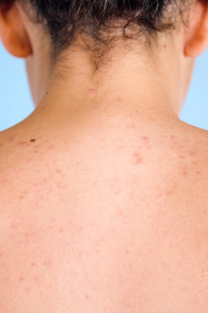 Back of a teenage girl with acne on her skin