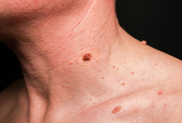 Big birthmark on the man's skin Medical health photo Papillomas on the neck