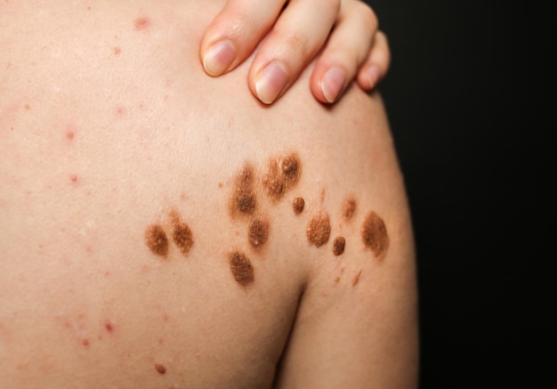 Big birthmarks and freckles on the girl's skin Medical health photo of back Woman's oily skin with problems acne