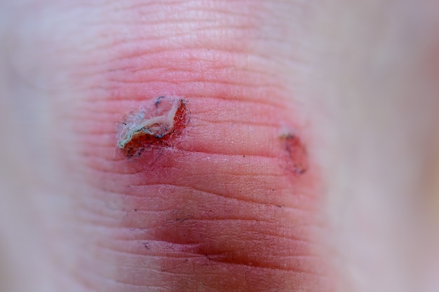 Big bloody calluses on man's heel close-up. Foot of man.