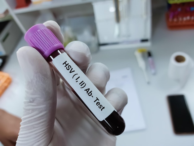 Biochemist of doctor holds blood sample for HSV 1 and HSV 2 test.