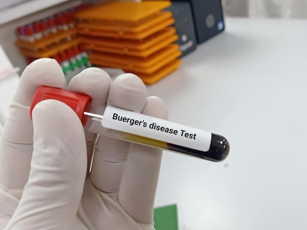 Biochemist or Lab Technologist holds Blood sample for Buerger's disease test.