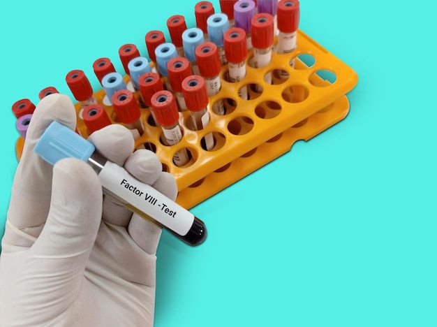 Biochemist or Lab Technologist holds Blood sample for factor VIII or antihemophilic factor test