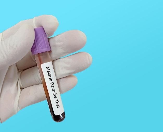 Biochemist or Lab Technologist holds Blood sample for Malaria Parasite test