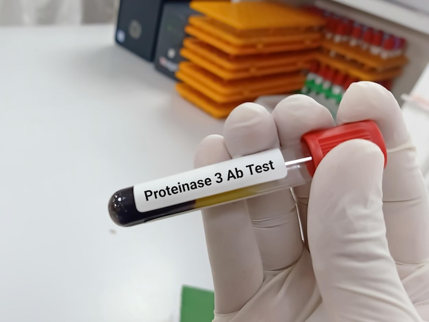 Biochemist or Lab Technologist holds Blood sample for Proteinase 3 Ab test.