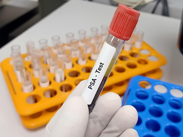 Biochemist or Lab Technologist holds Blood sample for PSA test