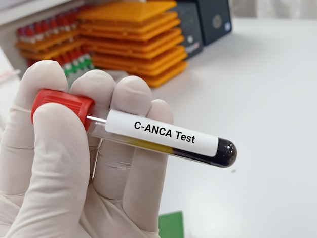 Biochemist or Lab Technologist holds Blood samples for cANCA (Anti-neutrophil cytoplasmic antibody),