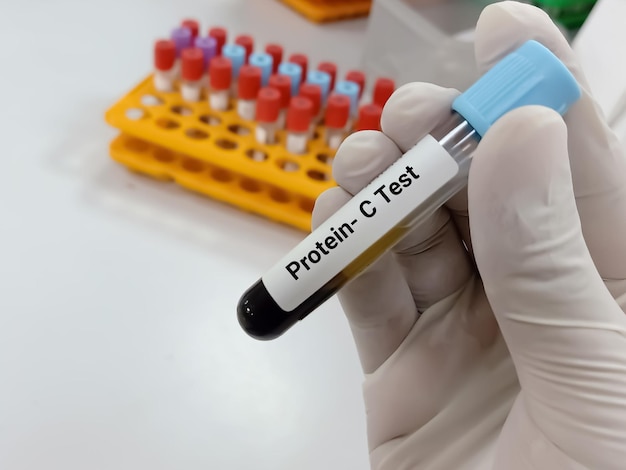 Biochemist or Lab Technologist holds Blood samples for protein C test with laboratory background.