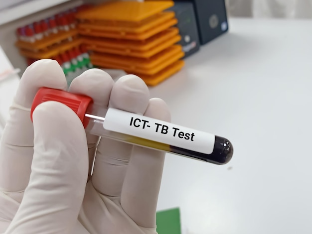 Biochemist or Lab Technologist holds Blood samples for Tuberculosis (TB) test. ICT for TB.