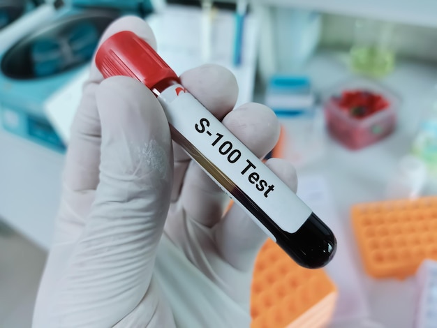 Biochemist of Scientist holds blood sample for S-100 test in laboratory background.