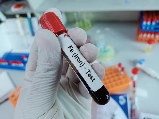 Biochemist of Scientist holds blood sample for Transferrin test. Iron deficiency anemia, TIBC.