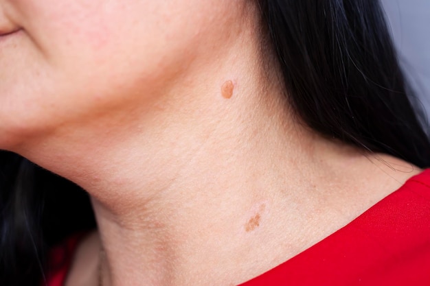 Birthmarks on skin Close up detail of the bare skin Sun Exposure effect on skin Health Effects of UV Radiation Woman with birthmarks Pigmentation and lot of birthmarks