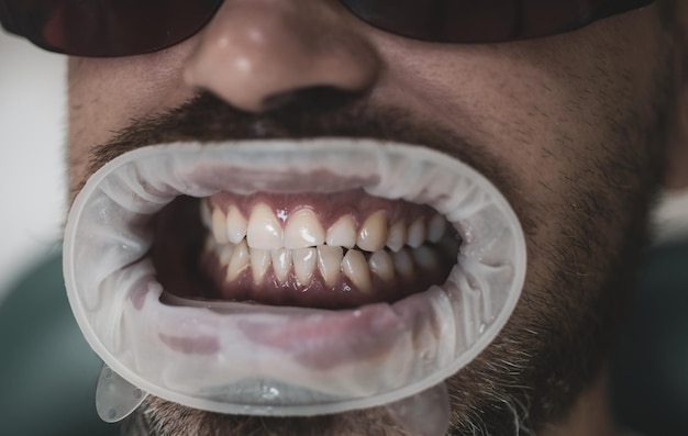 Bleaching of the teeth at dentist clinic Administer anesthetics to keep patients from feeling pain during procedures Comparison after teeth whitening Whitening teeth