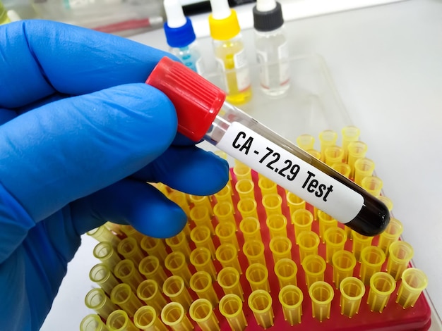 Blood sample for CA-27.29 test, diagnosis for breast cancer.