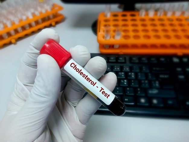 Blood sample for cholesterol test