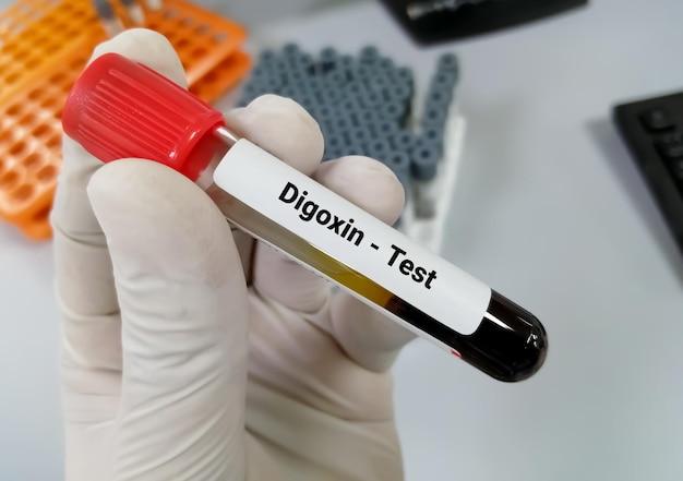 Blood sample for Digoxin level test a drug for heart disease