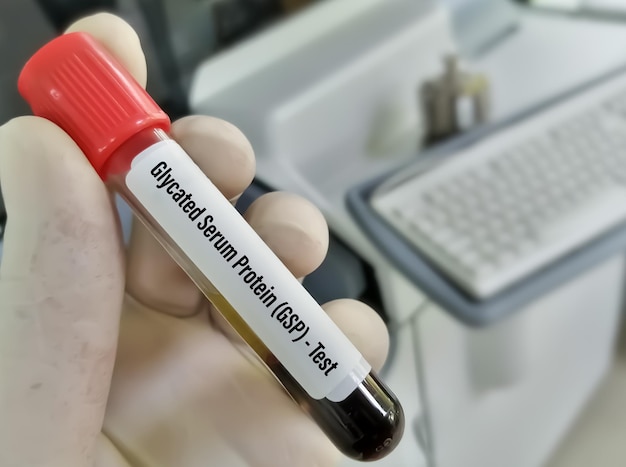 Blood sample for Glycated Serum Protein (GSP) test, diabetic testing concept.