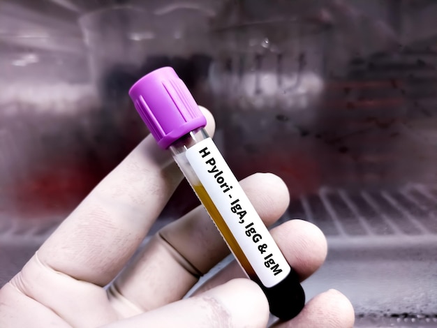 Blood sample for H. Pylori (IgA, IgG and IgM) test, Helicobacter pylori test. diagnosis Helicobacter