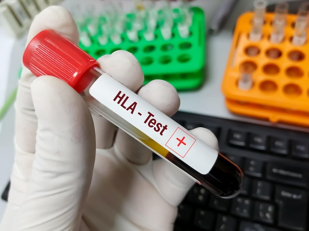 Blood sample for HLA or human leukocyte antigen test