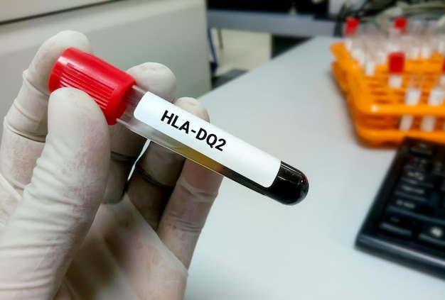 Blood sample for HLADQ2 test for the diagnosis of celiac disease