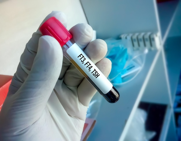 Blood sample for hormonal examination of thyroid gland in laboratory or Thyroid function testing