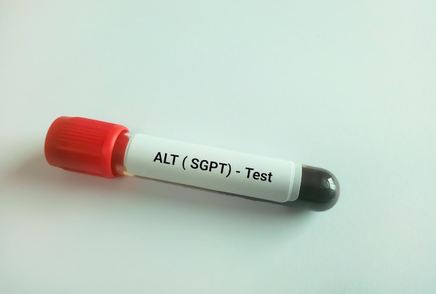 Blood sample isolated for ALT or SGPT test for Liver function test