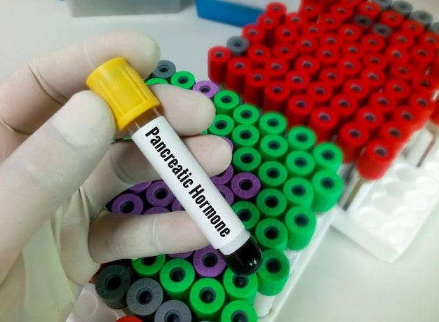 Blood sample for Pancreatic Hormone test. Insulin, Glucagon.