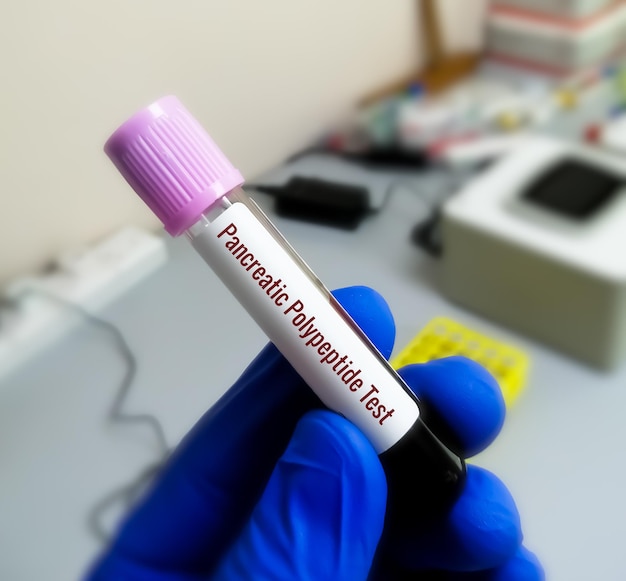 Blood sample for Pancreatic Hormone test. Insulin, Glucagon.