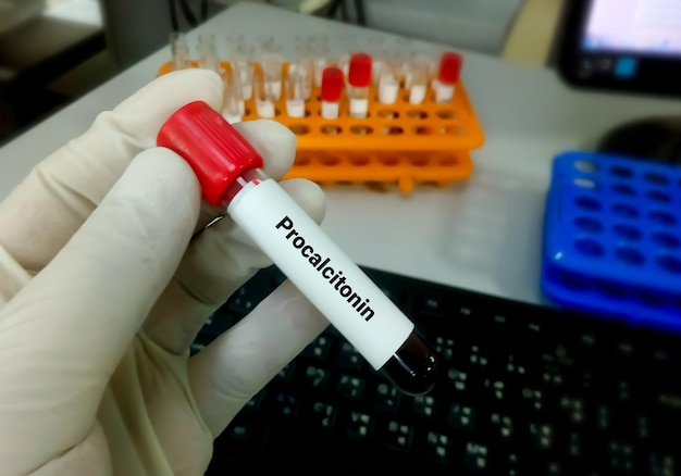 Blood sample for Procalcitonin test