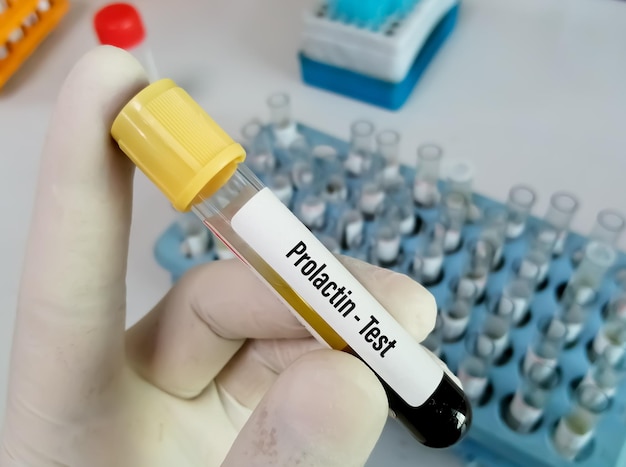 Blood sample for Prolactin hormone test