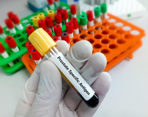 Blood sample for Prostate Specific Antigen or PSA test for the diagnosis of prostate cancer