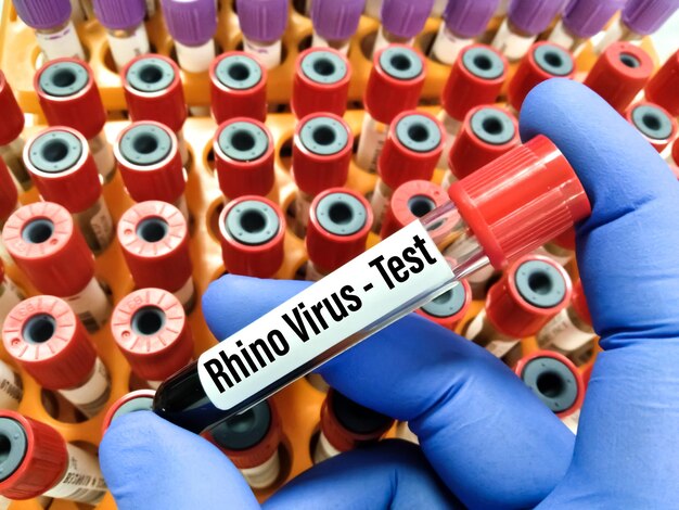 Blood sample for Rhino virus test