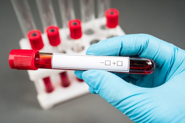 Blood sample test and empty tube blood for blood test screening with blank label for your text in laboratory