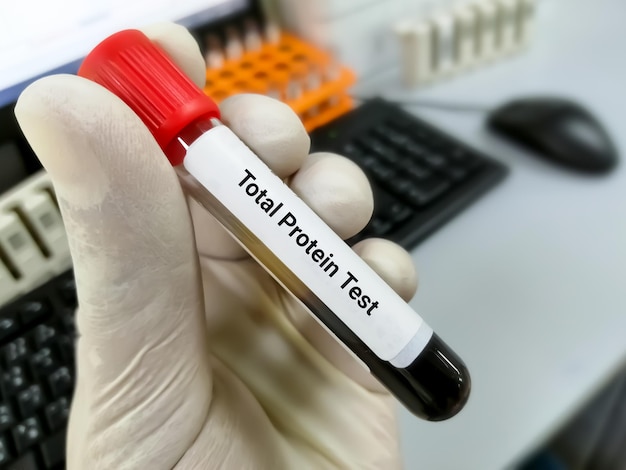 Blood sample for Total Protein test liver function testing