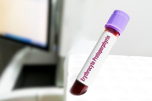 Blood sample tube for Erythrocyte protoporphyrin test, diagnosis of anemia disease